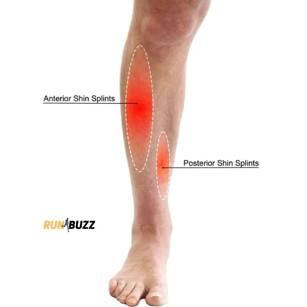 shin splints are a common overuse injury in runners