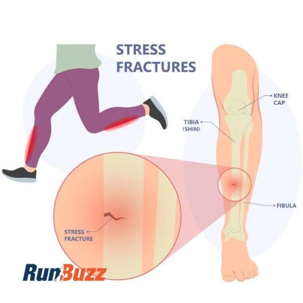 illustration showing a tibia stress fracture